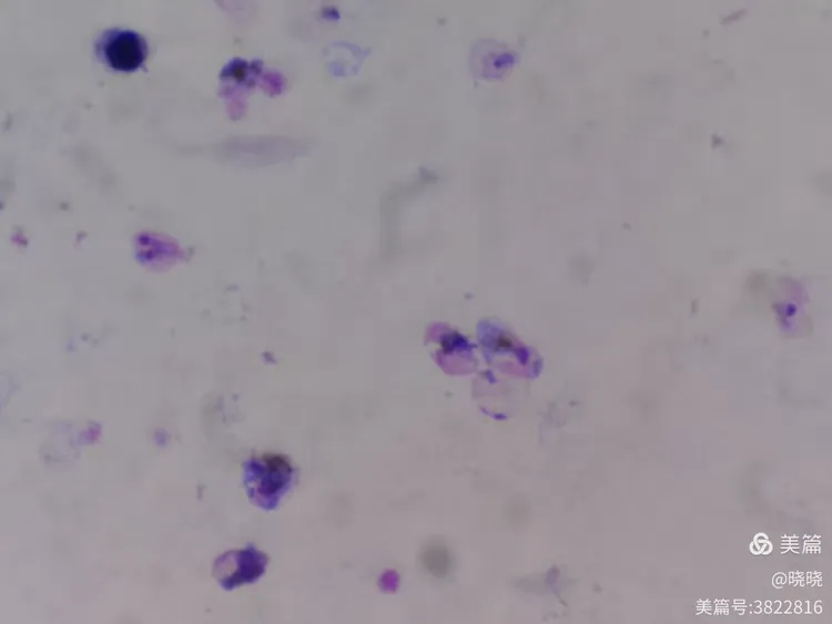 三种疟原虫厚膜染色法对比